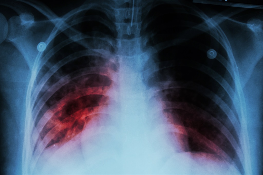 A chest x-ray showing alveolar infiltration due to tuberculosis.Picture: File