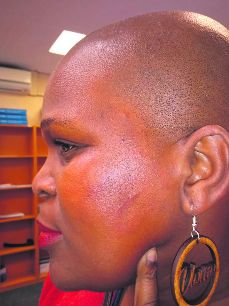 Betty Duli-Mkinase with a swollen face and bruises after she was allegedly attacked by Nyanga police in her shack.