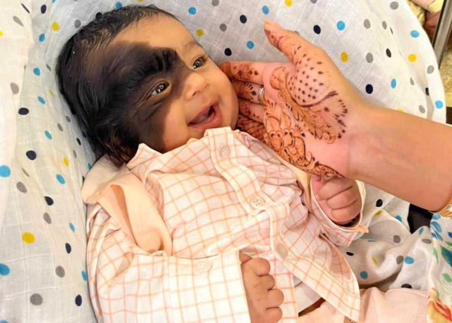 Little boy with birthmark on his face  Avyukt Kalra