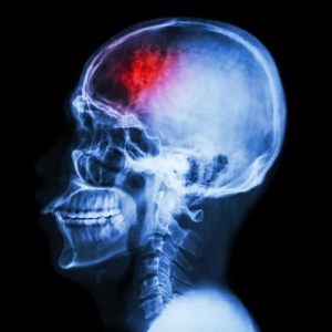 A positive outlook may help recovery from a stroke. 