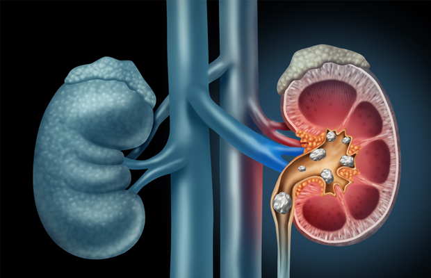 Illustration of kidney and stones