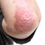 Psoriasis associated with depression