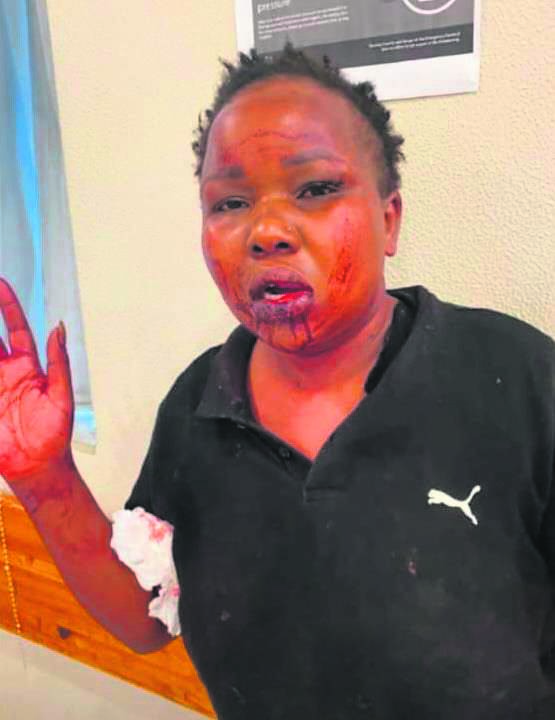 Penelope “Penny” Chadambura suffered physical injuries at the hand of her alleged boyfriend Luzuko Funani.Foto: sSupplied