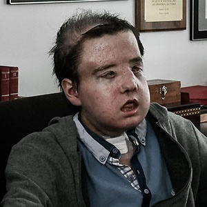Jerome Hamon recently underwent a second face transplant, a medical first. (AFP)