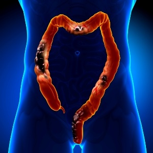 Some colon cancers start spreading at a very early stage.  