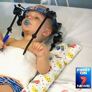 Sixteen-month-old Jackson Taylor underwent a miracle surgery that reattached his severed head to his neck after a car crash last month. Source: 
