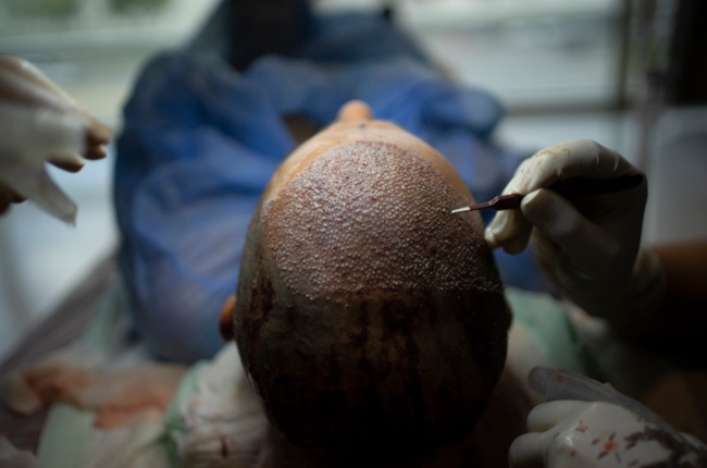 Is hair transplantation safe? As male weave and extension use rises,  surgeon unpacks transplantation | Drum