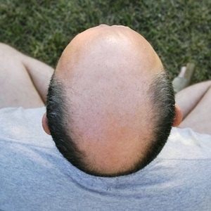 Could this be the end of baldness?