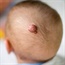 More than a birthmark: My family's experience of infant hemangioma