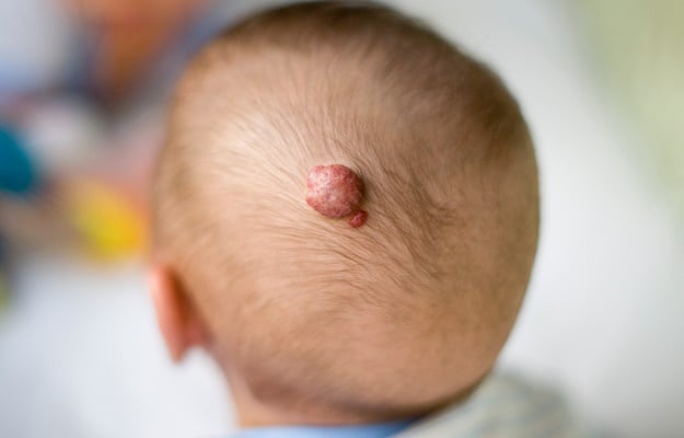 Hemangioma or strawberry birthmarks could appear on various parts of a baby's body.