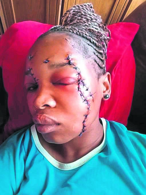A 30-year-old mother ended up with a huge scar on her face after being hit with a bottle during an altercation. 