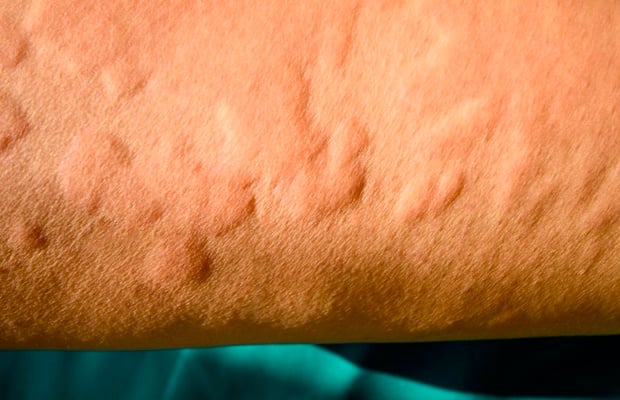 hives skin allergy