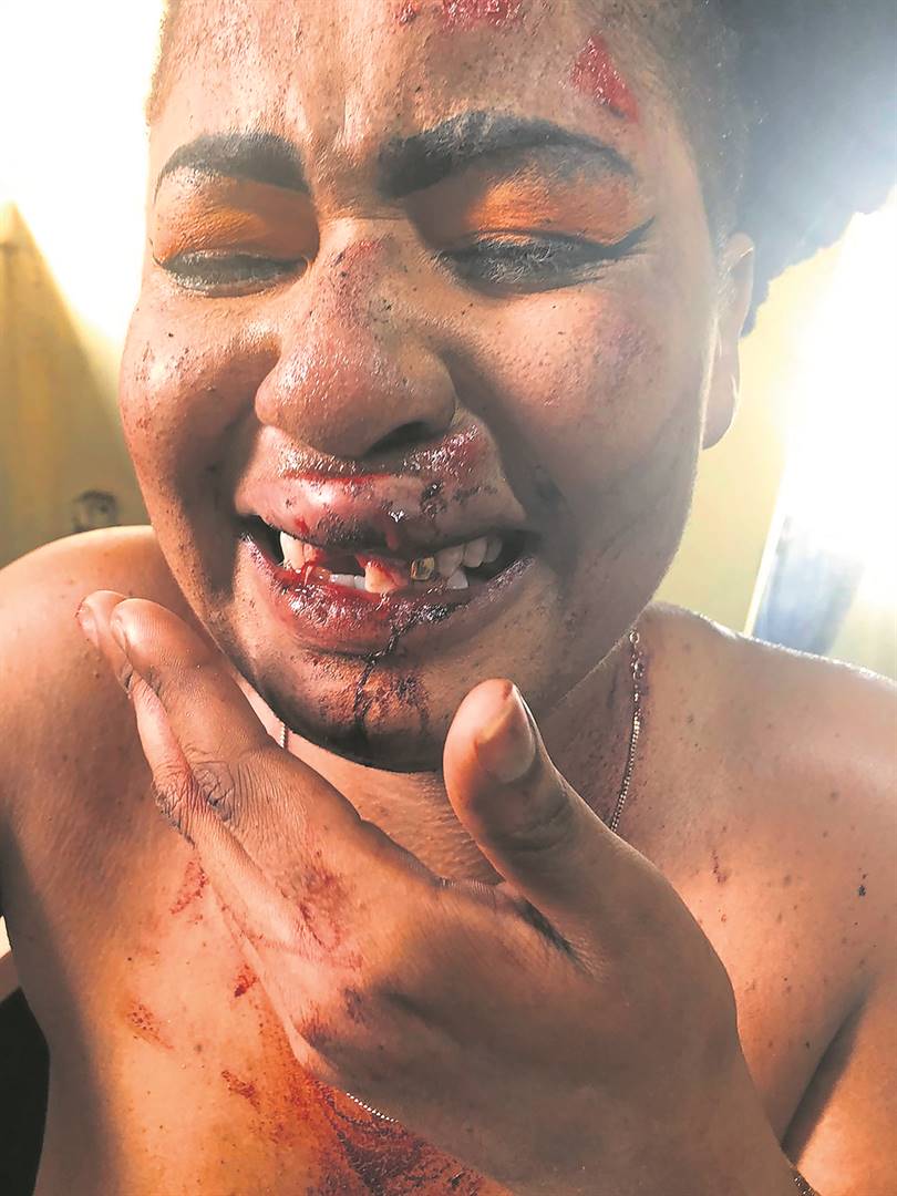 Nompumelelo Mkize lost her front tooth after she was allegedly assaulted by a taxi driver.