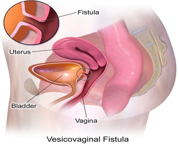 Risk factors for incontinence | Health24