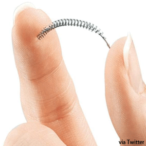 The Essure birth control implant