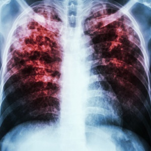 A more effective drug offers new hope to TB patients. 