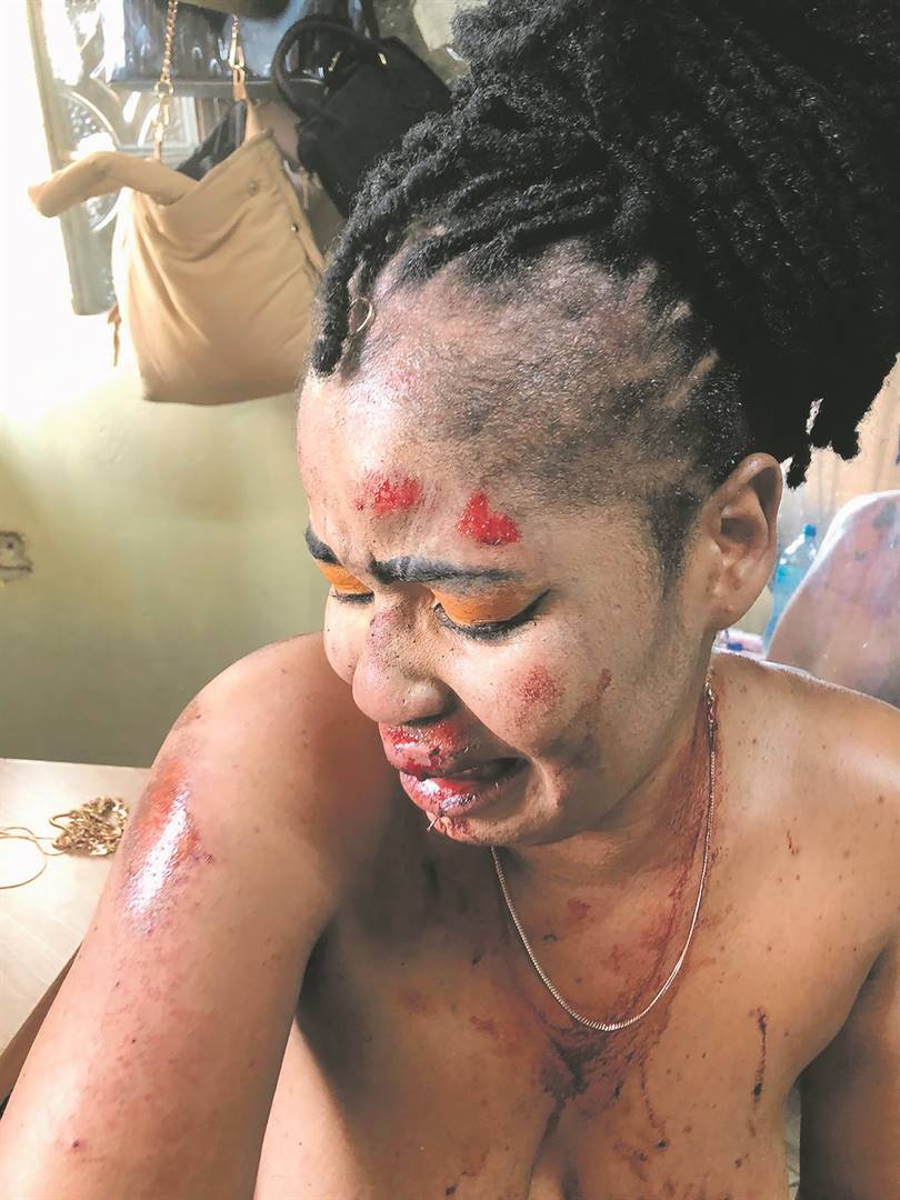 Nompumelelo Mkhize lost her front tooth after she was allegedly assaulted by the driver.