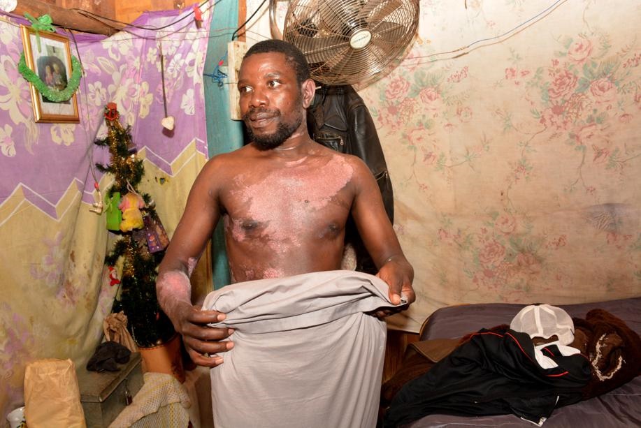 France Manaka (34) is lucky to be alive after his girlfriend burnt him two week ago with boiling water while he was asleep. Photos by Morapedi Mashashe 