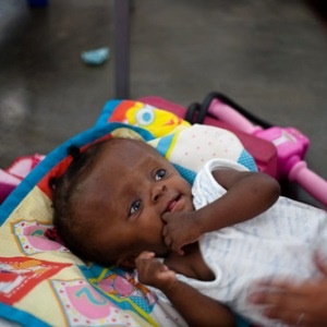 A baby born with hydrocephalus in Haiti.