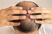 Signs and symptoms of hair loss