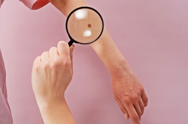 Is evolution to blame for our susceptibility to melanomas?