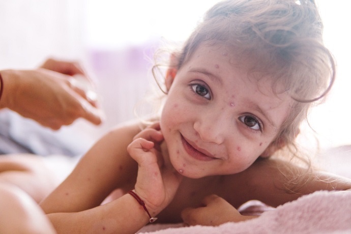 Measles is contagious three or four days before a rash appears on the skin, making it highly communicable