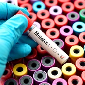 Mpumalanga confirms cases of measles