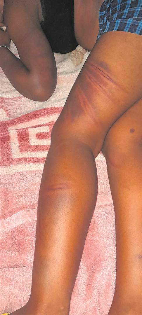 The marks on the legs of the pupil who was badly injured. 