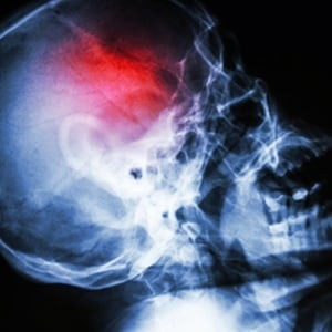 Weight gain is common among patients who have experienced a traumatic brain injury. 