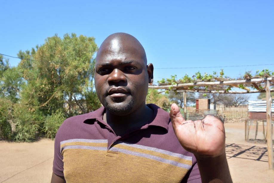 Believe Makhubela from Winterveld in Tshwane fears his fingers could be used for muthi.  Photo by Morapedi Mashashe