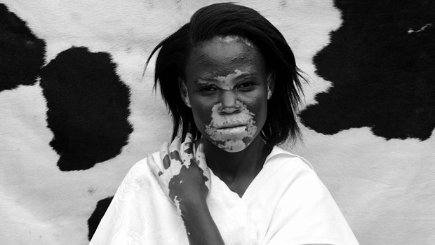 Reatile Moalusi’s series Mollo Wa Badimo on the skin condition vitiligo shares an intimate account of the individual’s experiences. Pictures: Reatile Moalusi 