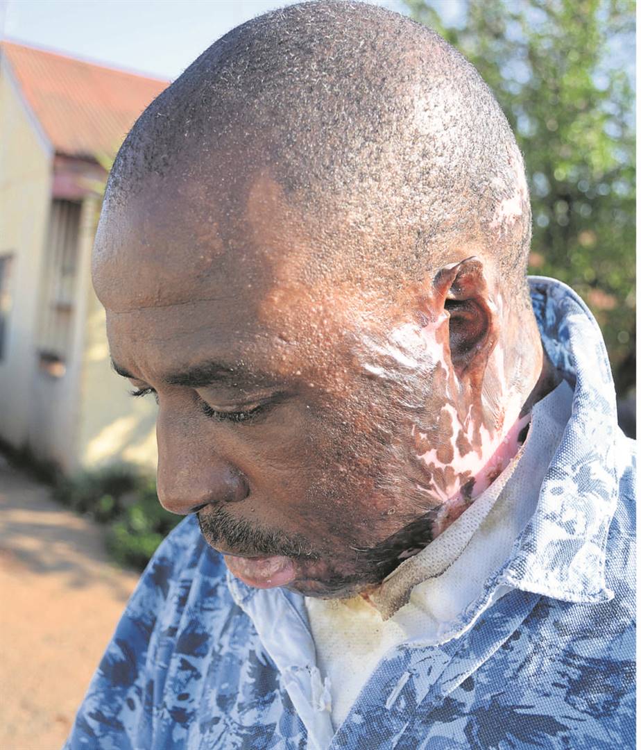 Mathemba Nyakombi says his jealous girlfriend attacked him.             Photo by Muntu Nkosi