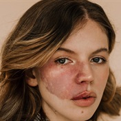 Beautiful from birth: Bullied for birthmark on her face but that didn't stop her from being a model