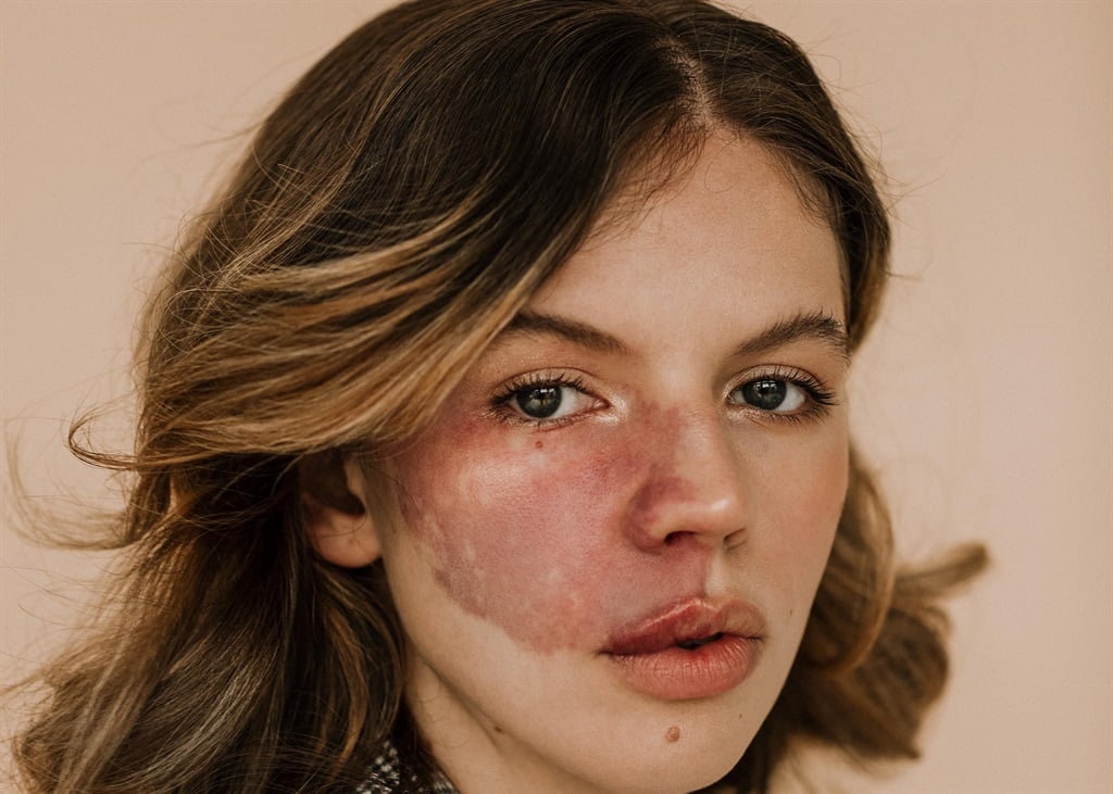 Model Anna Nevine, 24, shows off her prominent birthmark. 