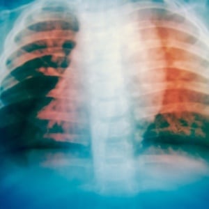 A new approach to TB medication could considerably decrease recovery time. 