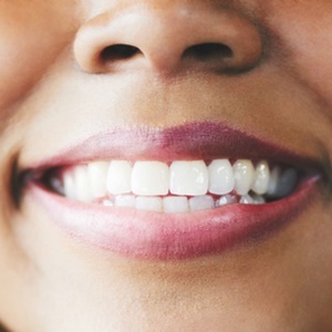 Unblemished teeth allow you to smile with confidence. 