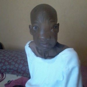 Vhonani Netshifhefhe (42) of Tshikombani village has contracted a rare form cancer that has deformed her face over the past two years.