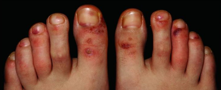 Is Covid Toes A Thing What The Latest Study Says Health24