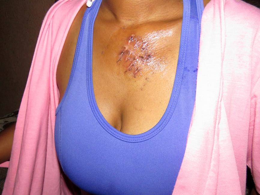SURVIVOR: The young woman shows the wound made by the man who tried to cut into her chest.
Photos by Ntebatse Masipa
