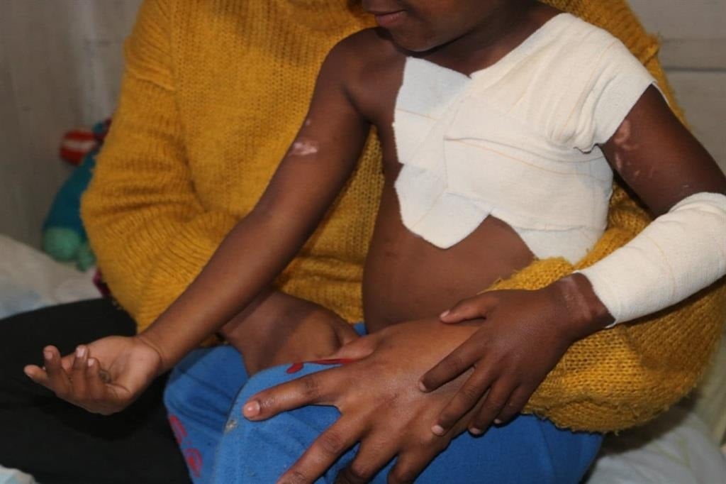 A mum said her son was left with burn wounds all over his upper body. Photo by Lulekwa Mbadamane 