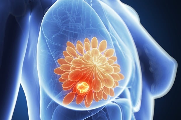 3d rendered illustration of breast cancer