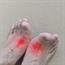 Genes, not diet, may be key to gout flare-ups