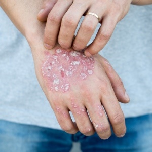 Eczema can cause psychological damage. 