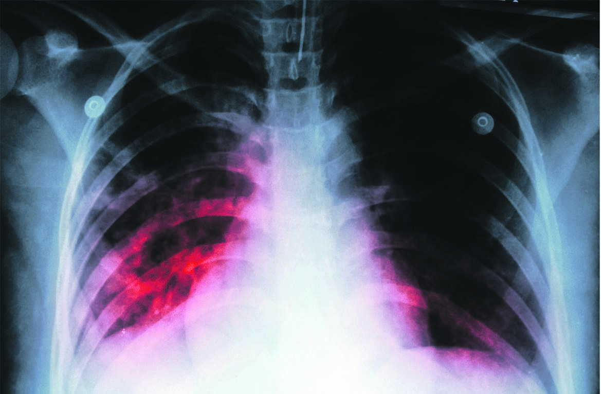 A chest X-ray shows the effect of mycobacterium tuberculosis infection on the lungs of a TB patient. 