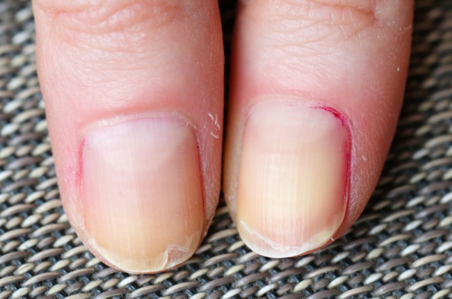 Top more than 144 vertical lines on nails nhs latest