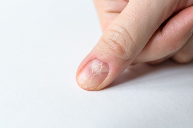 Brittle Nail Syndrome: Background, Symptoms of Brittle Nail Syndrome,  Pathophysiology