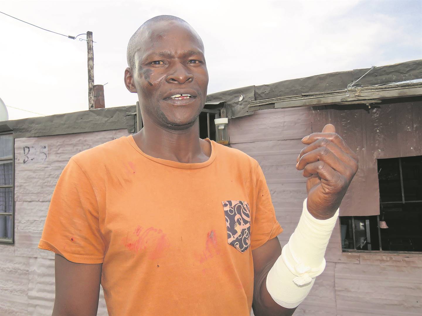 Paul Makobetsi also got burnt when he tried to take away the acid from the man’s hands.  ealso with acid, on Valentines Day. The woman is in hospital.  Photo by Ntebatse Masipa
