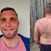MY STORY | My skin condition led me to drugs and booze – now I use my story to help others 