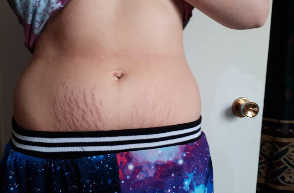 Chantelle Clarke, new mom to a two-month old baby girl, added before and after images on Facebook of her stretchmarks below her belly. On the left, the stretch marks are a deep purple colour and the right, well, they seem to have faded significantly after her 2-week “experiment”. (Chantelle Clarke)
