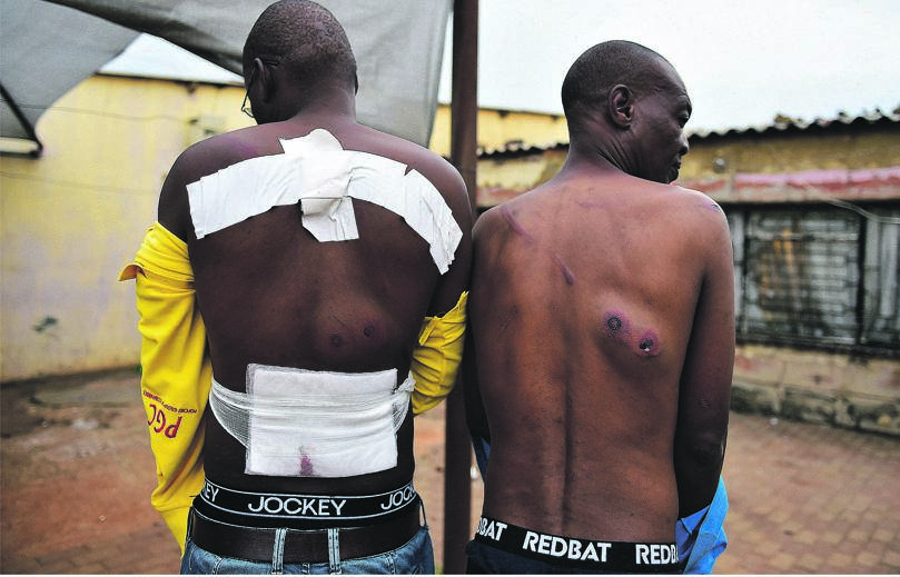 Victims of the lockdown shooting in Vosloorus Zulu section show their injuries.  Photo by Christopher Moagi